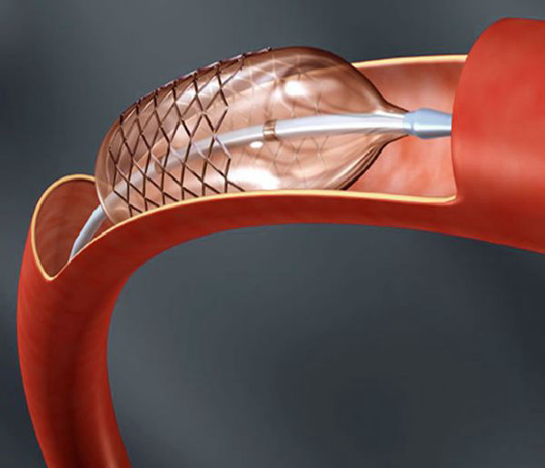 Cirurgia endovascular